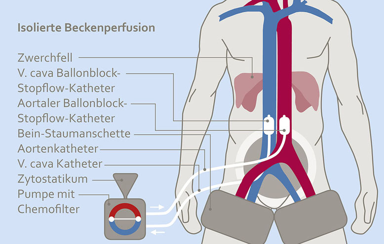 izole bölgesel kemoterapi